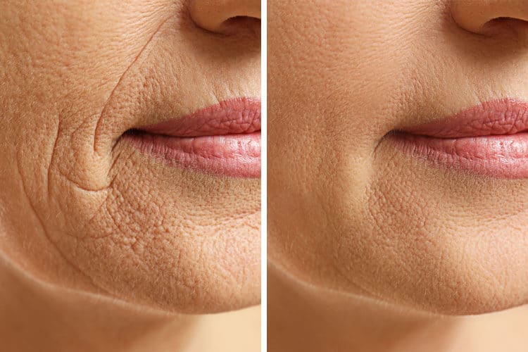 Treatment-Cosmetic-Smokers-Lines-1