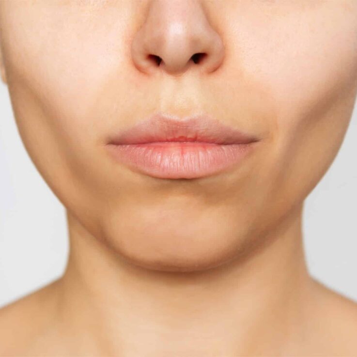 RS_Buccal_Fat RS_Buccal_Fat